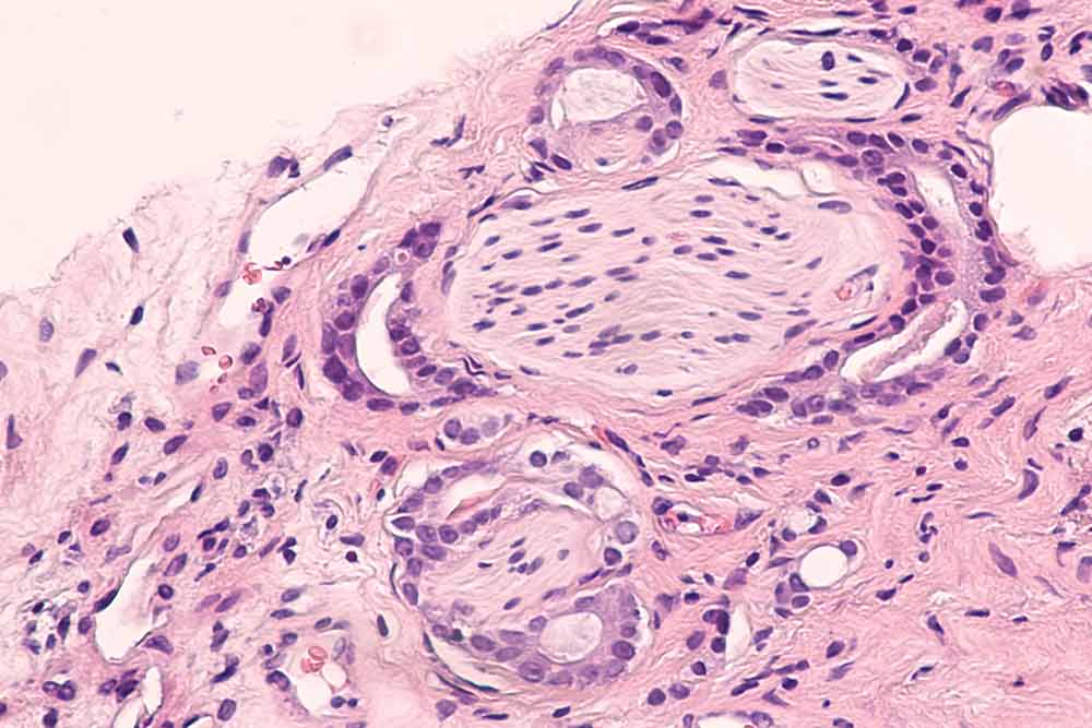 pathologie behandelkeuze prostaatkanker uitvergroot beeld van aangekleurd pathologisch weefsel