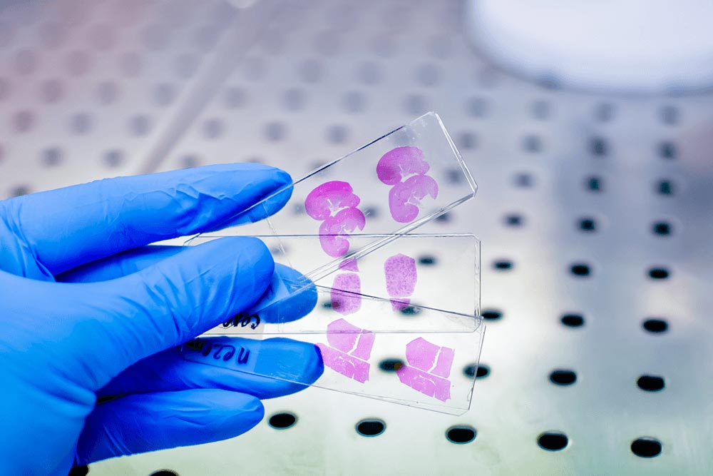Evaluatie van lymfeklieren bij micro-invasieve baarmoederhalskanker Evaluatie van lymfeklieren bij micro-invasieve baarmoederhalskanker