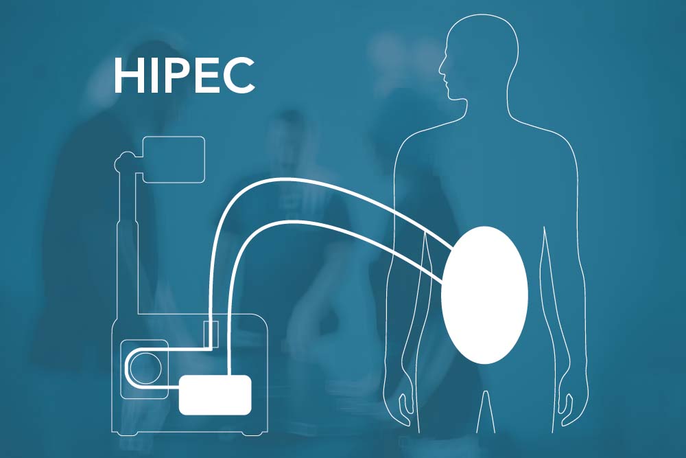 Geen verschillen overleving na CRS + HIPEC met mitomycin C of oxaliplatin