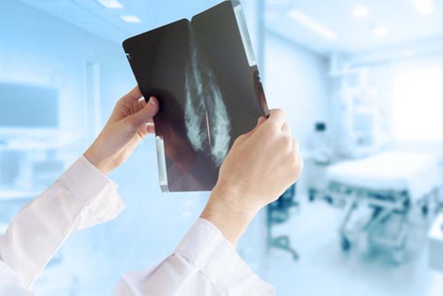 Door de COVID-19 crisis zijn er minder borstkankerdiagnoses Door de COVID-19 crisis zijn er minder borstkankerdiagnoses