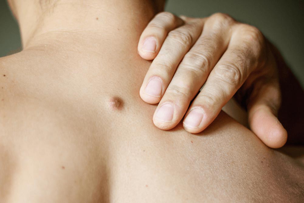 Behandel dermatofibrosarcoma protuberans (DFSP) met Mohs-microchirurgie Behandel dermatofibrosarcoma protuberans (DFSP) met Mohs-microchirurgie